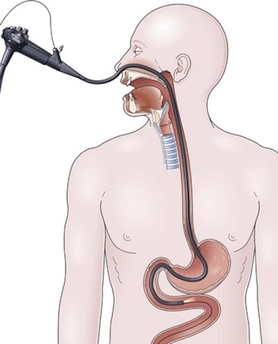 Gastroscopia Transnasale Gastroenterologia Endoscopia Digestiva Studio Specialistico